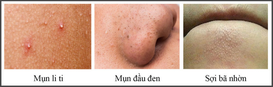 3 loại mụn không viêm hay gặp phải