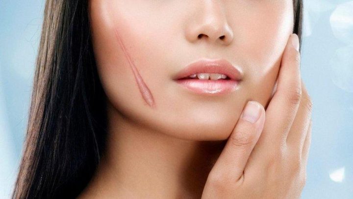 Tổng hợp những cách làm mờ sẹo lồi hiệu quả nhất hiện nay