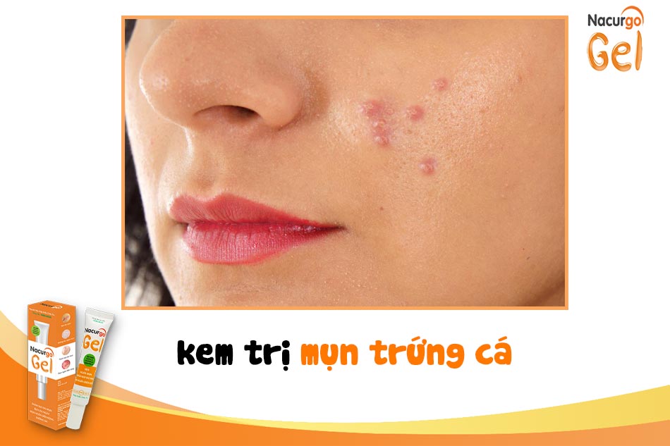 Kem trị mụn trứng cá