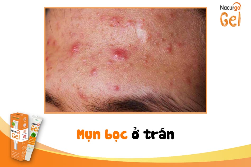 Mụn bọc ở trán