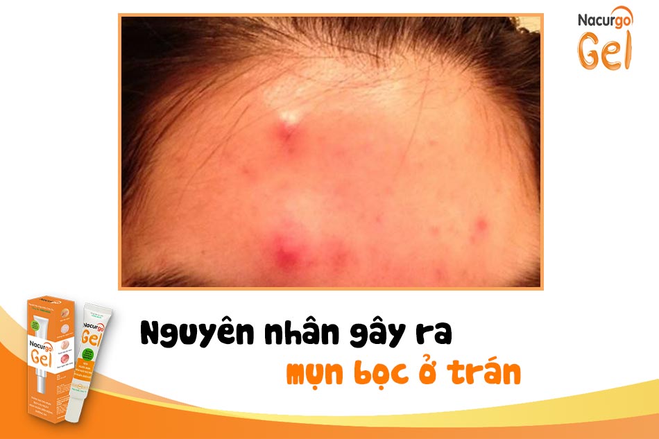 Nguyên nhân gây ra mụn bọc ở trán