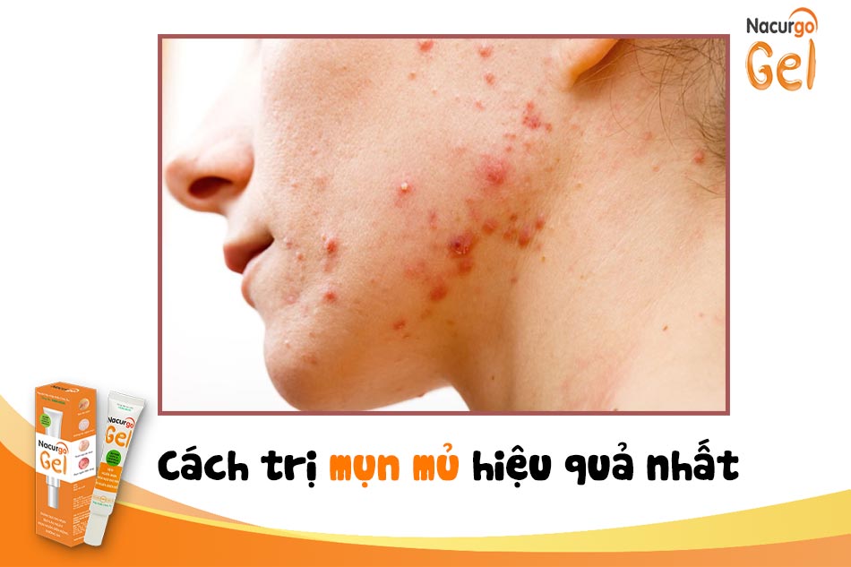 Cách trị mụn mủ hiệu quả nhất