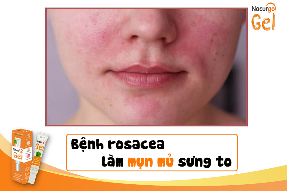 Bệnh Rosacea làm mụn mủ sưng to