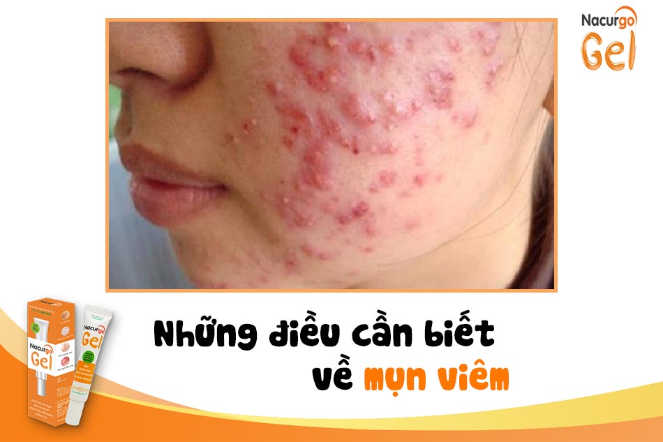 Những điều cần biết về mụn viêm