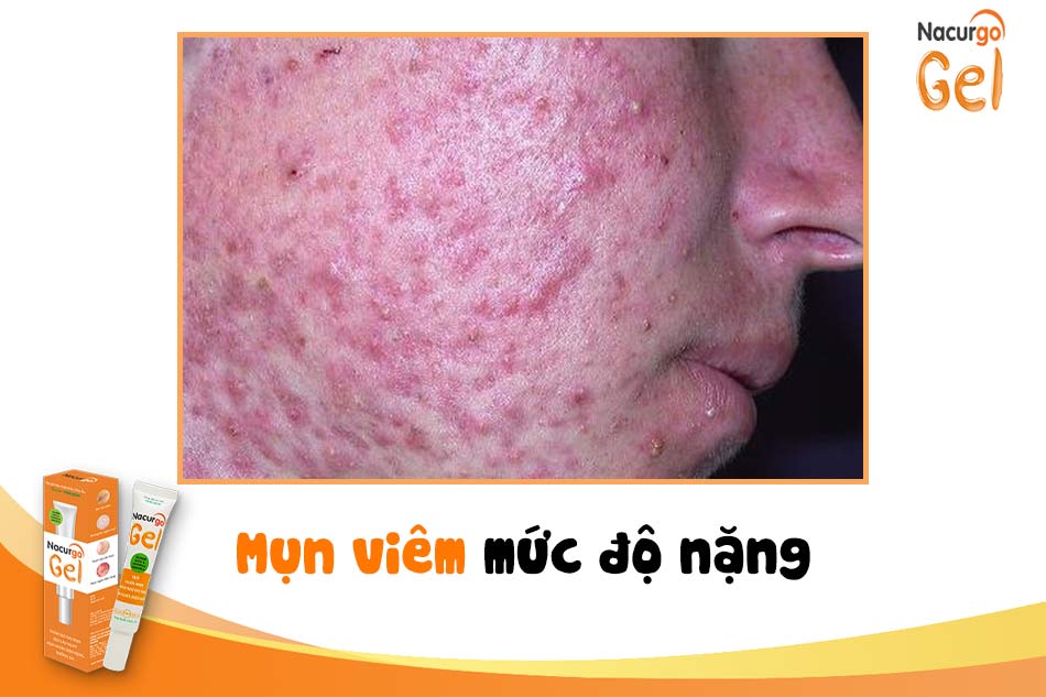 Mụn viêm ở mức độ nặng