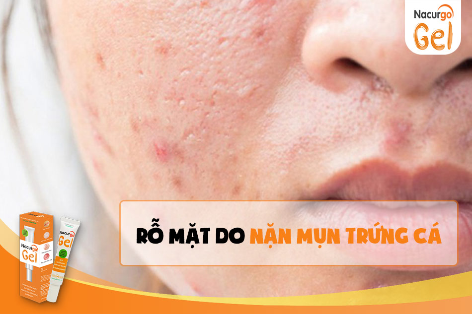 Nặn mụn trứng cá có thể dẫn đến rỗ mặt