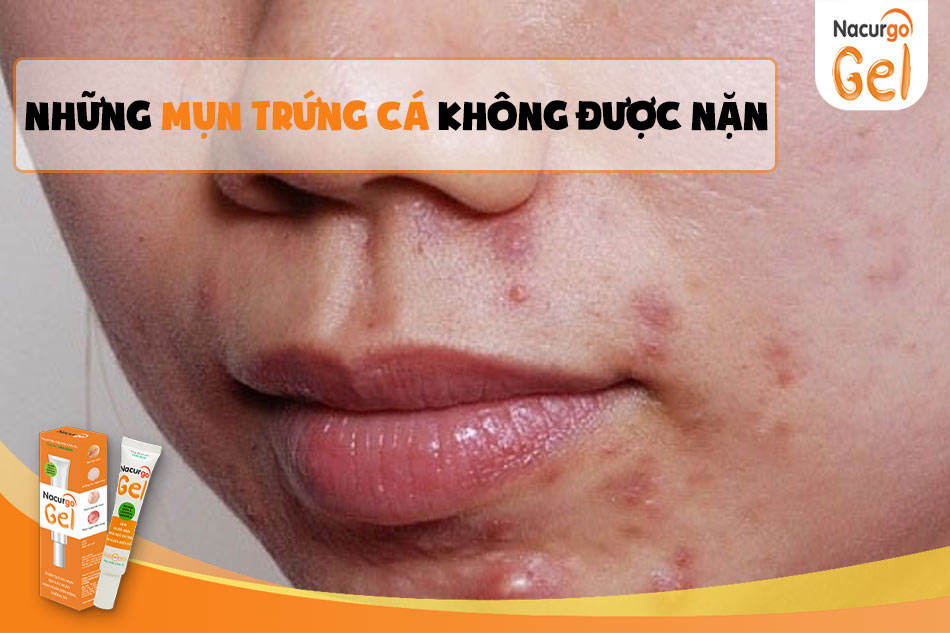 Những loại mụn trứng cá không được nặn