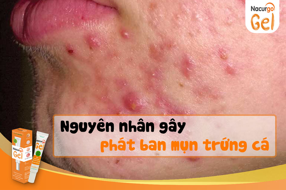 Nguyên nhân gây ra phát ban mụn trứng cá