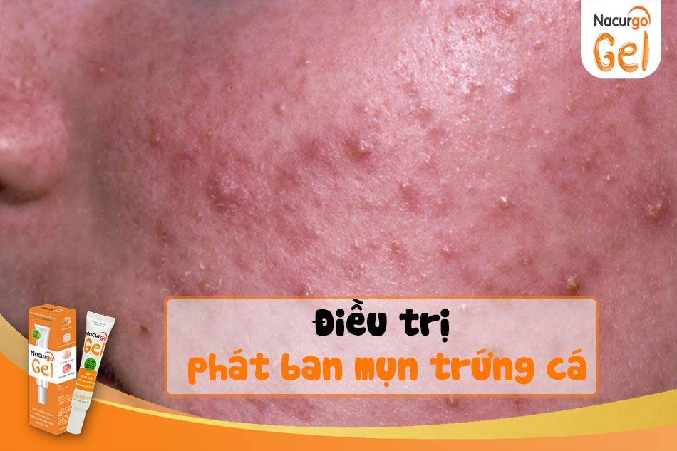 Cách điều trị phát ban mụn trứng cá