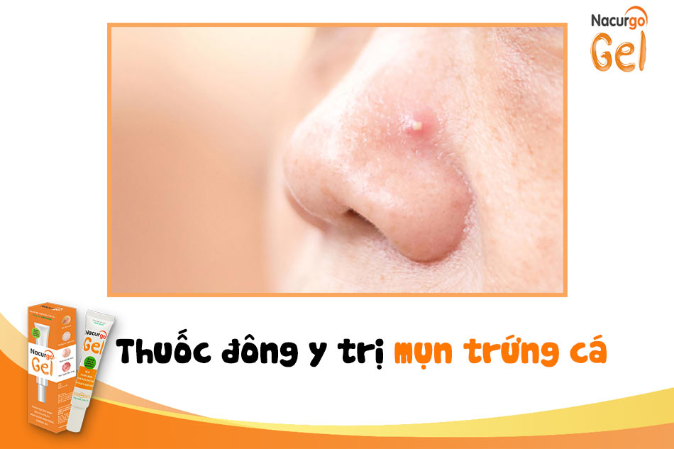 Thuốc Đông Y trị mụn trứng cá