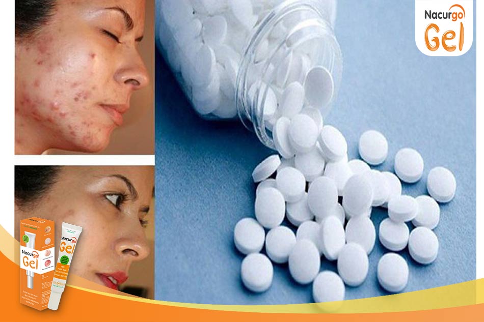 Aspirin chứa hoạt chất quan trọng để điều trị mụn bọc