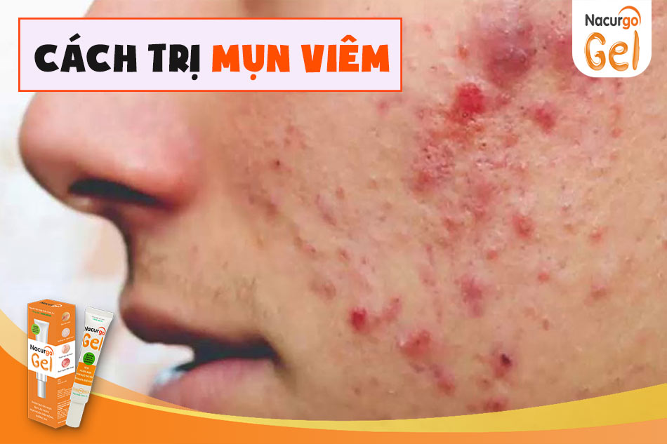 Cách trị mụn viêm đơn giản, hiệu quả