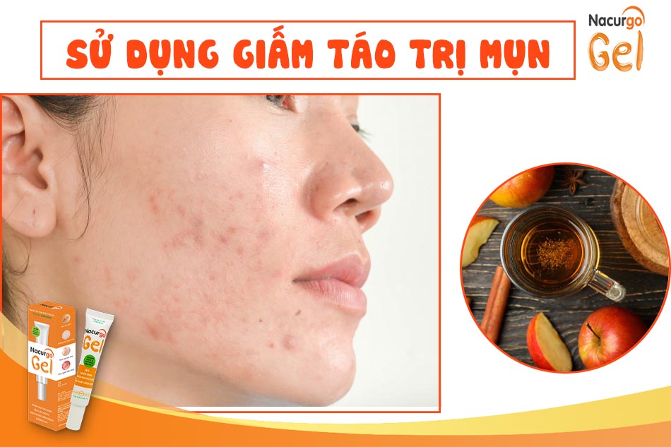 Sử dụng giấm táo trị mụn