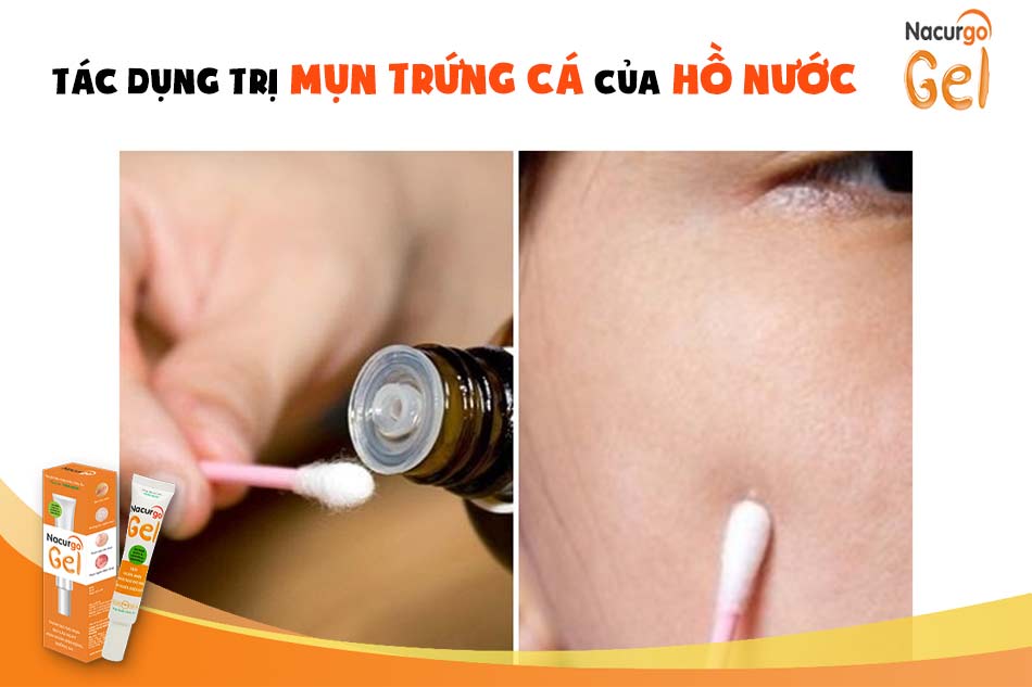 Hồ nước trị mụn trứng cá