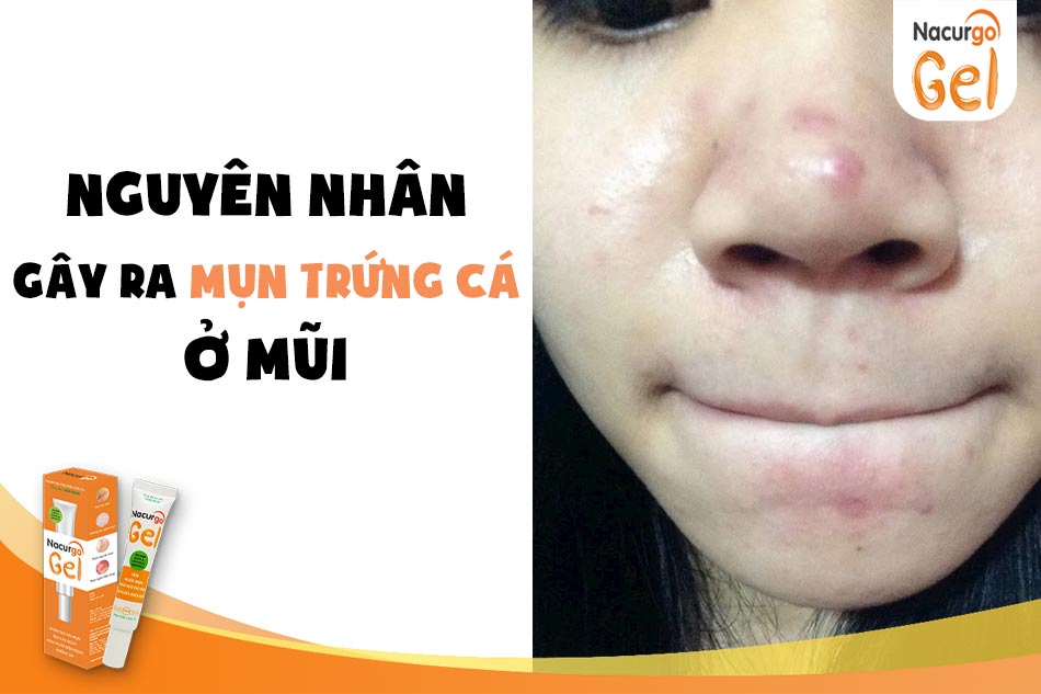 Mụn trứng cá ở mũi