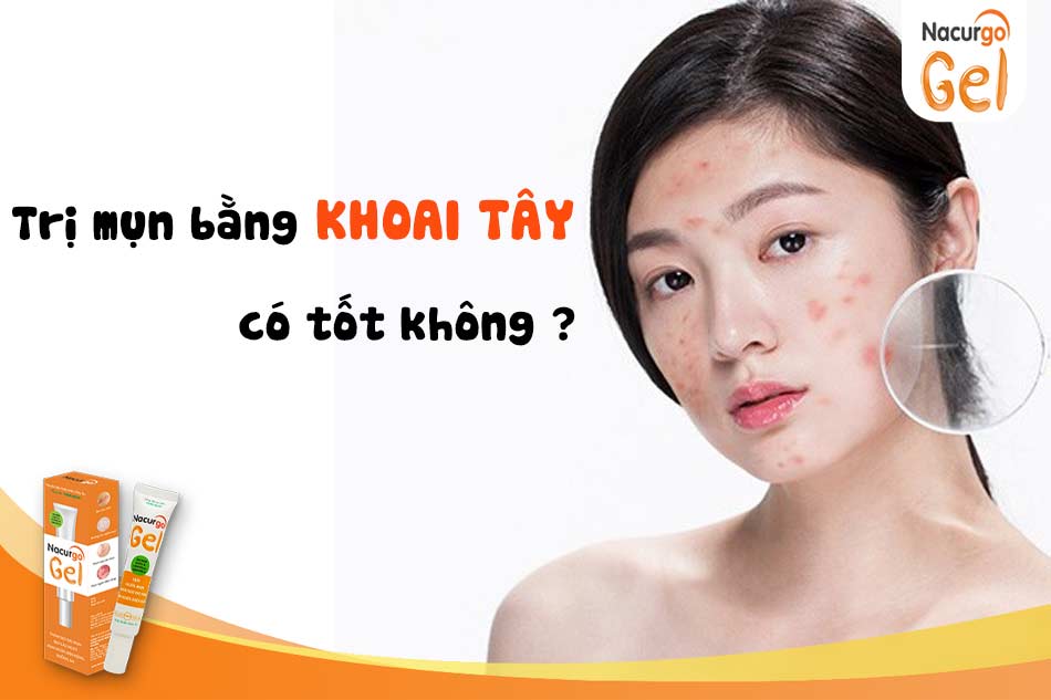 Trị mụn bằng khoai tây