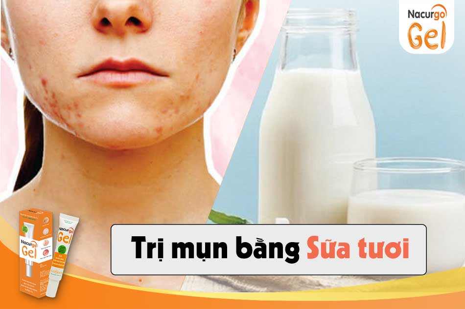 Trị mụn bằng sữa tươi