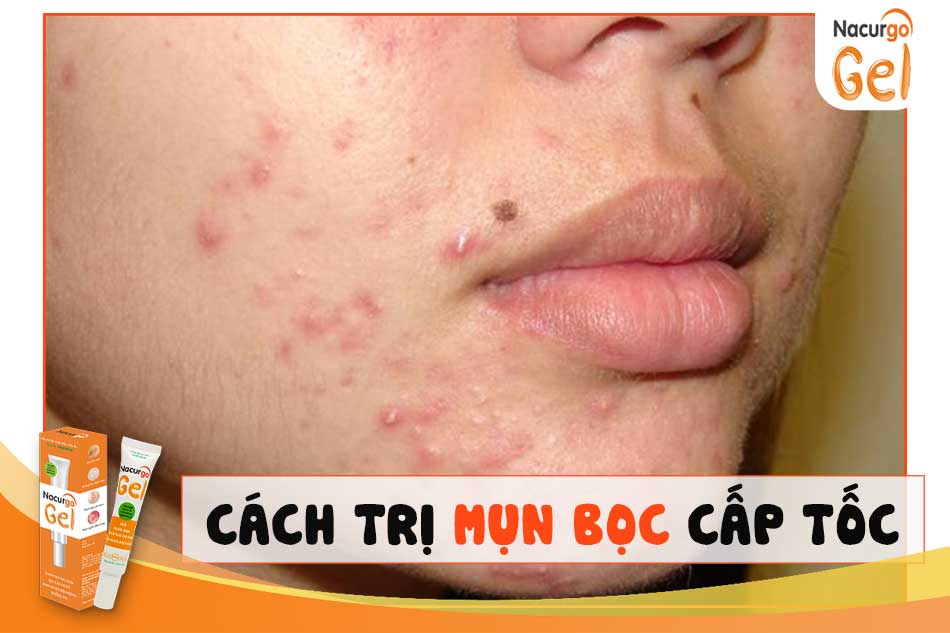 Cách trị mụn bọc cấp tốc tại nhà đơn giản, hiệu quả