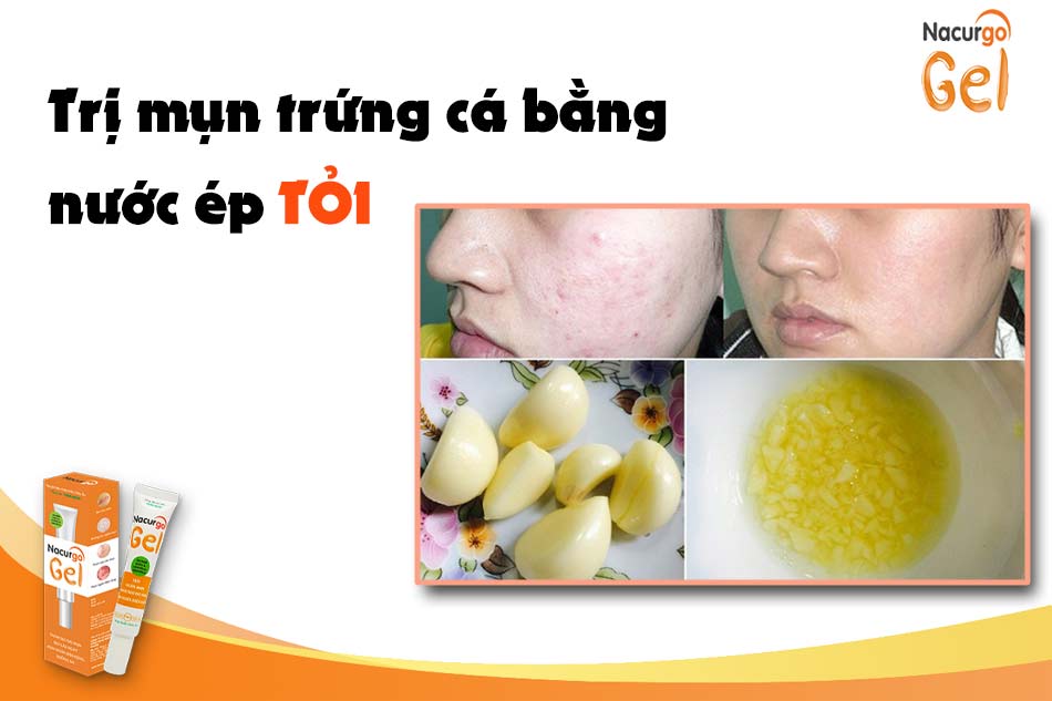 Trị mụn trứng cá bằng tỏi