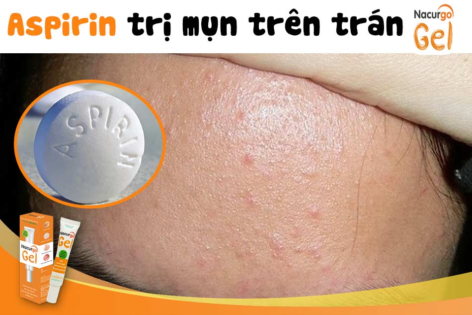 Aspirin trị mụn trứng cá trên trán