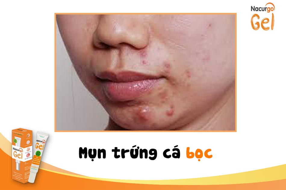 Mụn trứng cá bọc