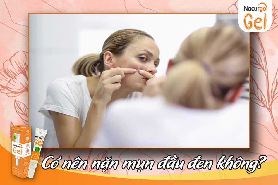 Có nên nặn mụn đầu đen không?