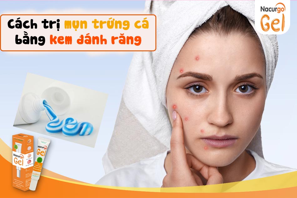 Có thể dùng Nacurgo Gel thay thế cho kem đánh răng để trị mụn