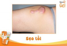 Sẹo lồi