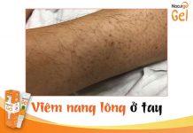 Viêm nang lông ở tay